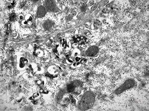 M,16y. | Wilson disease susp. M,16y. | Wilson disease susp.